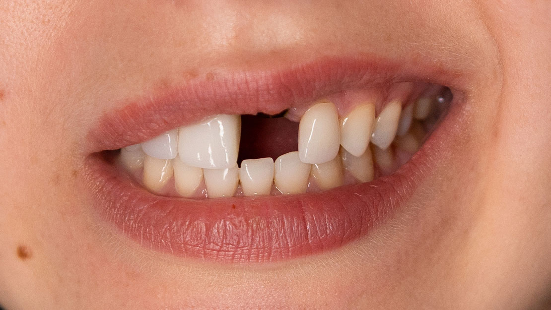Signature Dental Aesthetics - Missing Teeth Featured