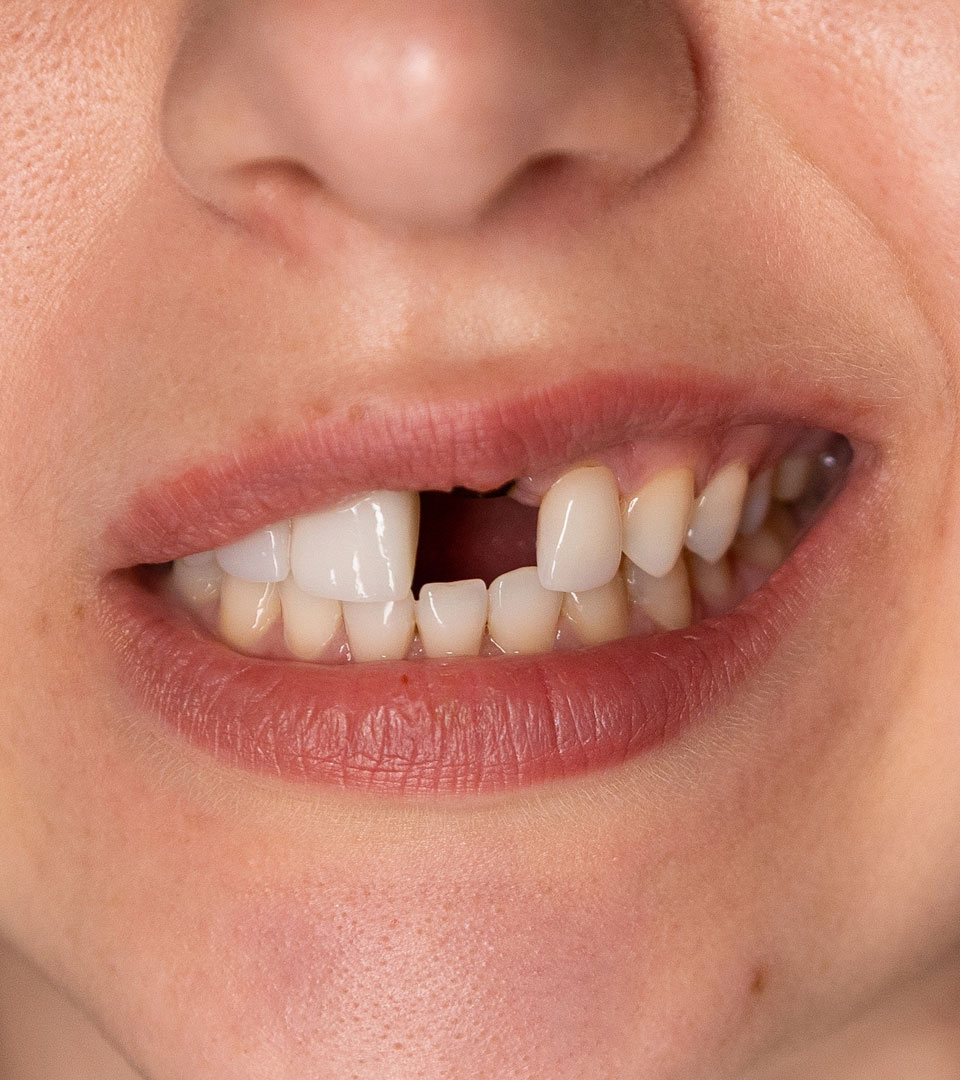 Signature Dental Aesthetics - Missing Teeth