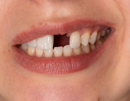 Signature Dental Aesthetics - Missing Teeth
