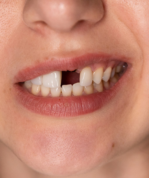 Signature Dental Aesthetics - Missing Teeth