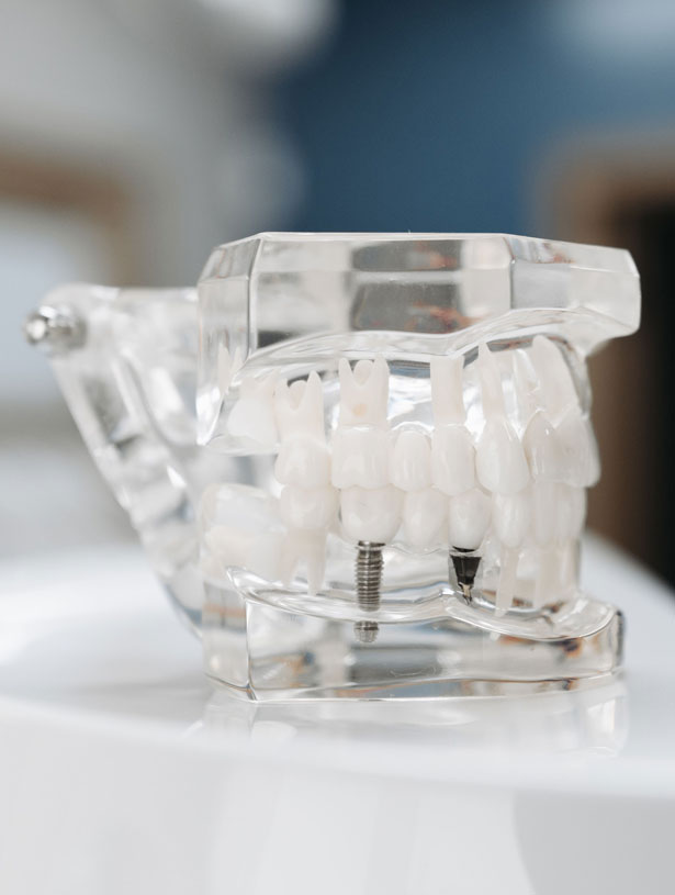 Signature Dental Aesthetics - What Are Advanced Implants