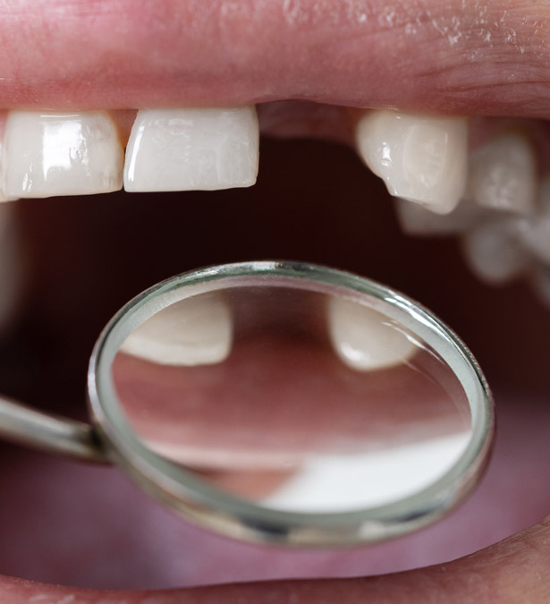 Signature Dental Aesthetics - What Is Missing Teeth