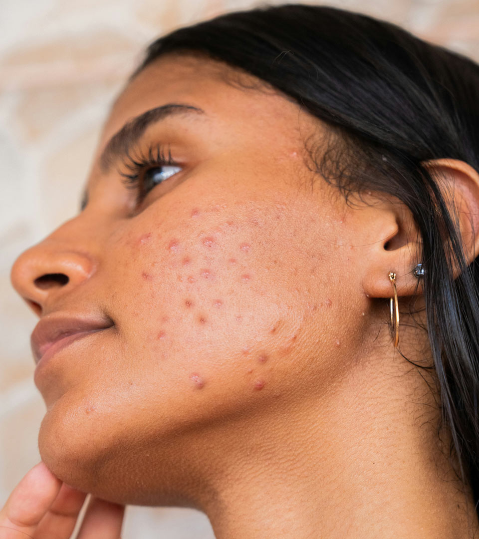 Signature Dental Aesthetics - Acne & Acne Scarring