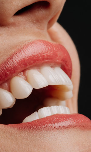 Signature Dental Aesthetics - Composite Veneers AAG