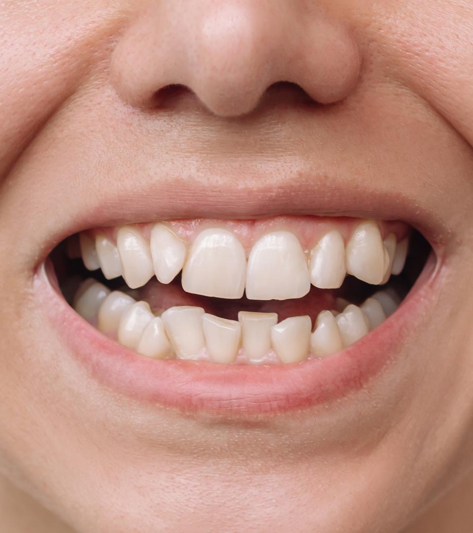 Signature Dental Aesthetics - Crowded Teeth Header