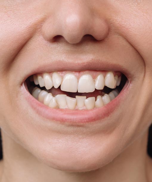 Signature Dental Aesthetics - Crowded Teeth Preview