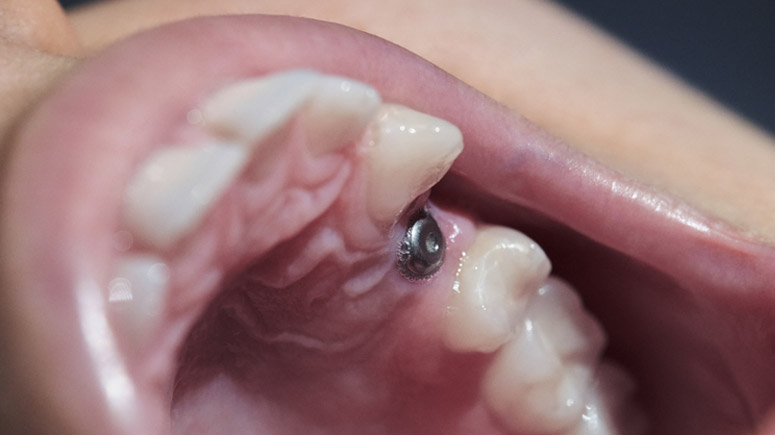 Signature Dental Aesthetics - Dental Implants In Bermuda: What To Expect From Consultation To Smile