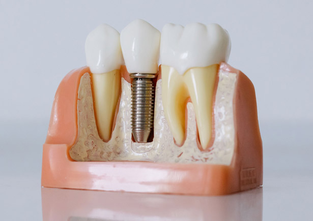 Dental Implants In Bermuda: What To Expect From Consultation To Smile