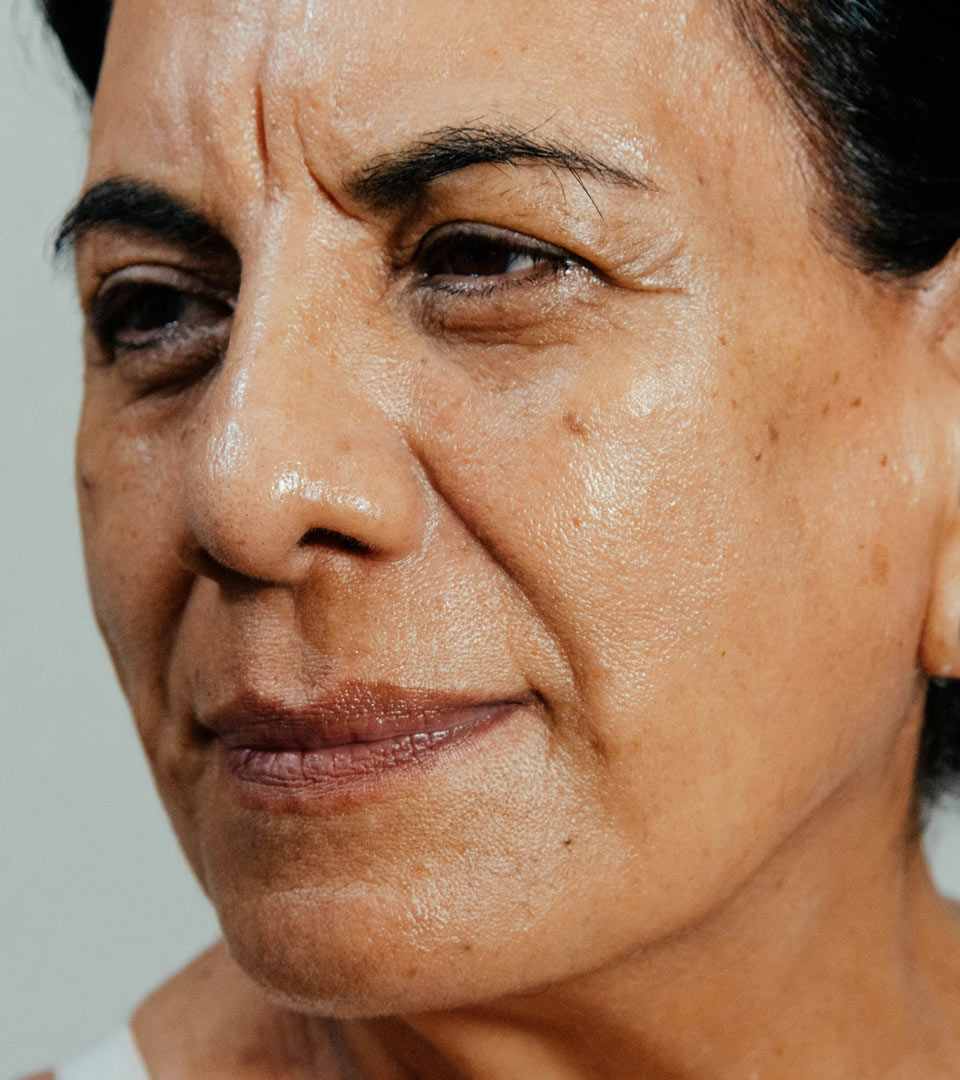Signature Dental Aesthetics - Facial Volume Loss