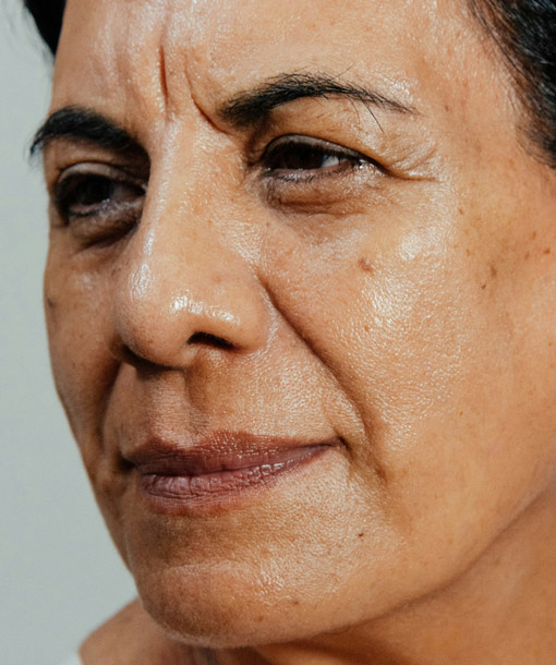 Signature Dental Aesthetics - Facial Volume Loss
