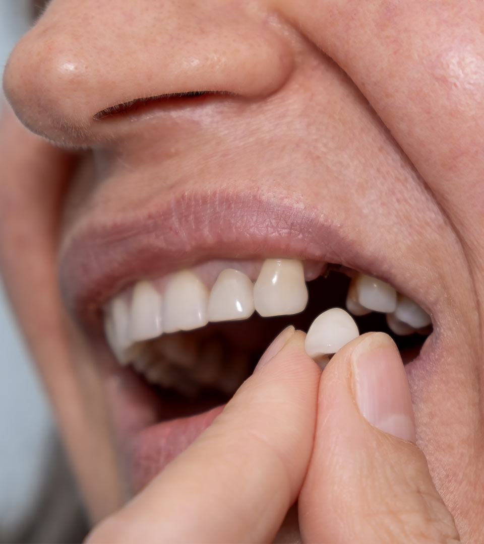 Signature Dental Aesthetics - Failing or Loose Implants