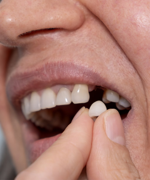 Signature Dental Aesthetics - Failing or Loose Implants