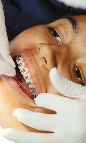 Signature Dental Aesthetics - Fixed braces AAG