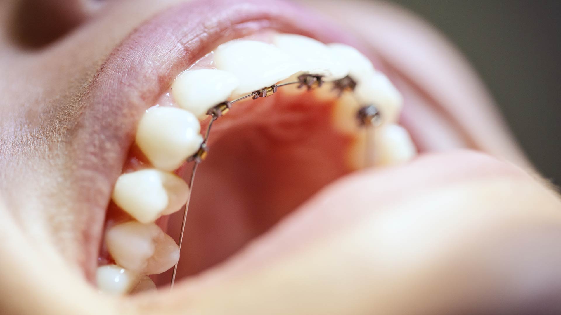 Signature Dental Aesthetics - Fixed Braces