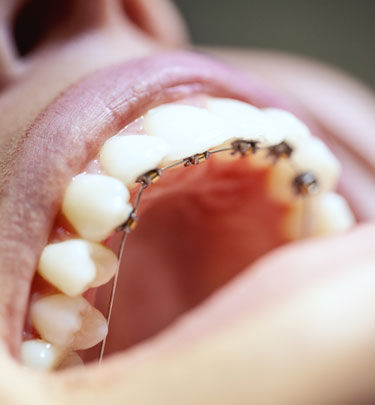 Signature Dental Aesthetics - Fixed Braces