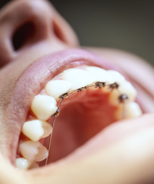 Signature Dental Aesthetics - Fixed Braces