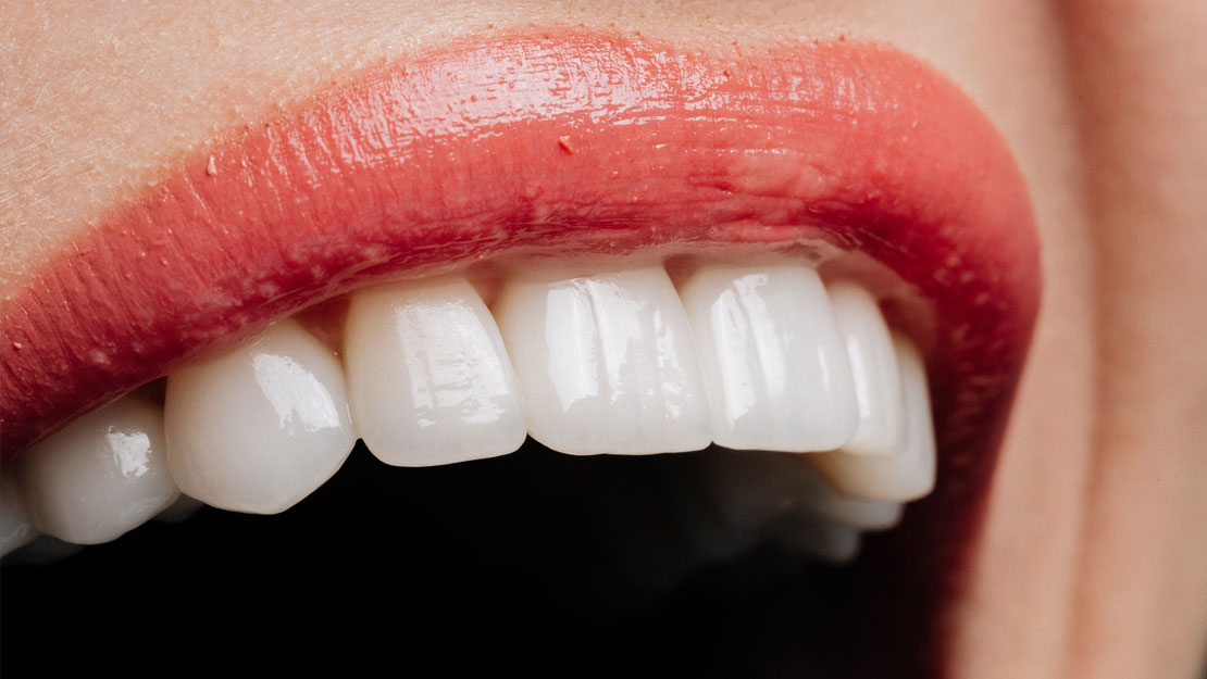 Signature Dental Aesthetics - Full-Arch Implants Featured
