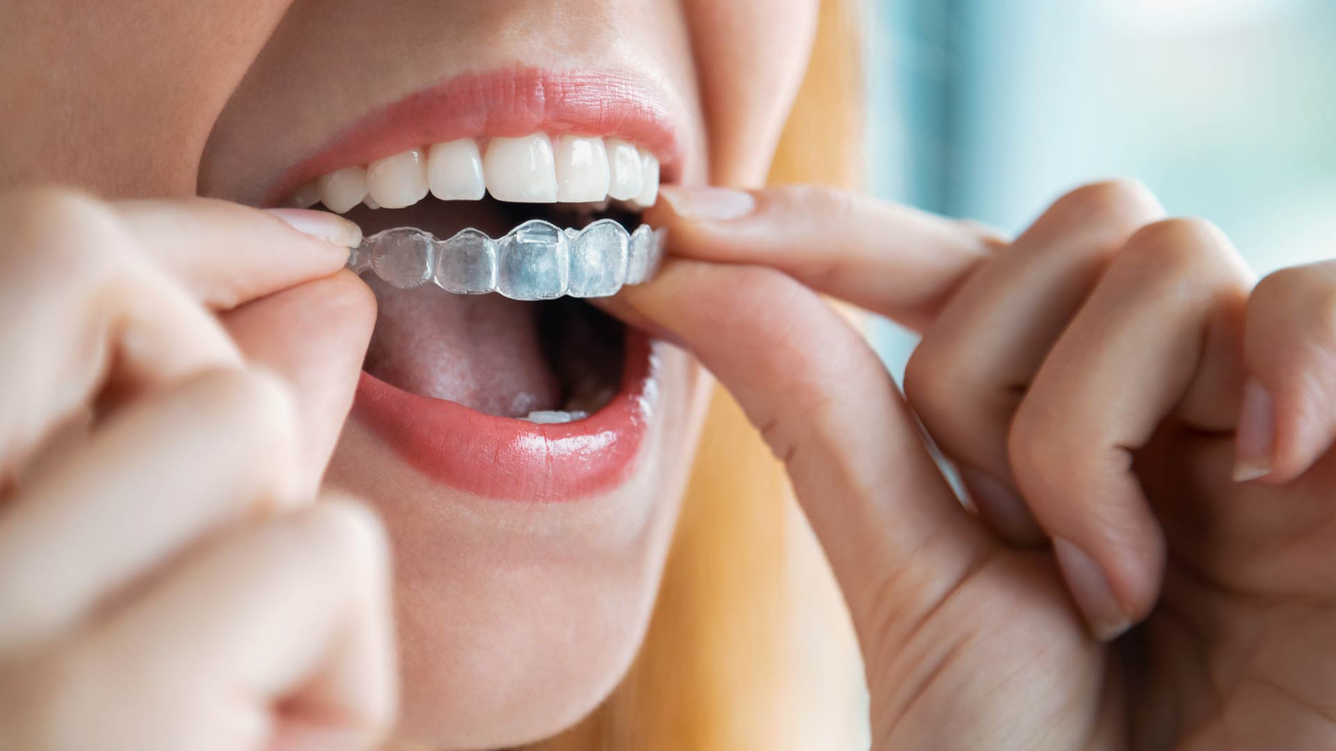 Signature Dental Aesthetics - Invisalign