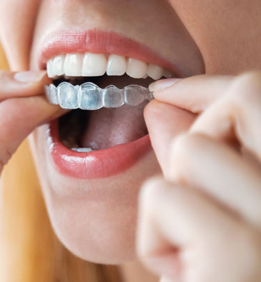 Signature Dental Aesthetics - Invisalign
