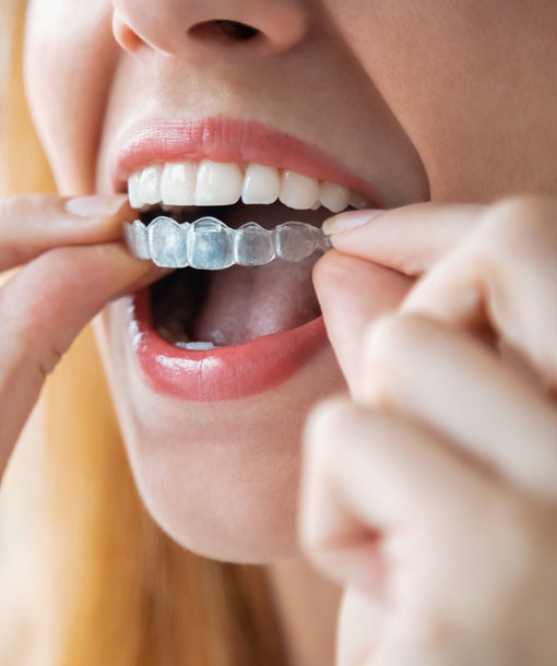 Signature Dental Aesthetics - Invisalign