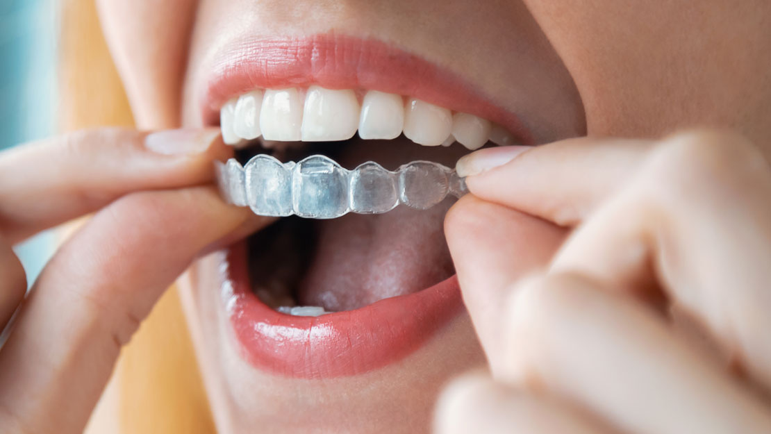 Signature Dental Aesthetics - Invisalign® Featured