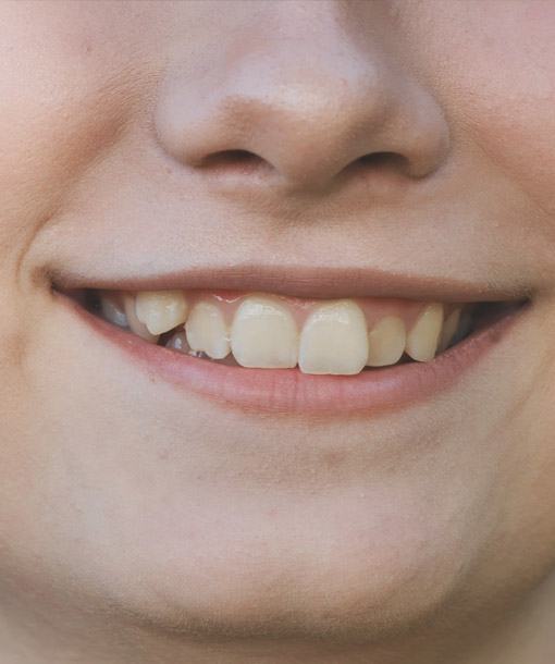 Signature Dental Aesthetics - Misshapen Teeth