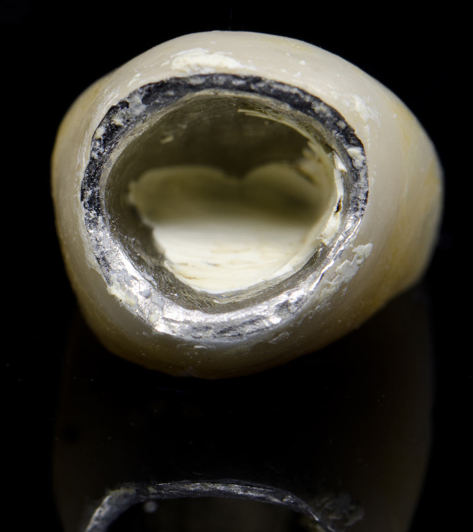 Signature Dental Aesthetics - Need Old Crowns Replaced