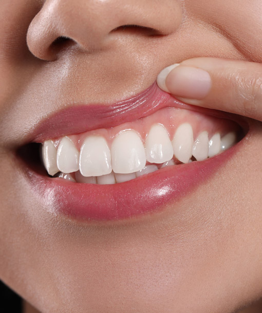 Signature Dental Aesthetics - Peri-implantitis