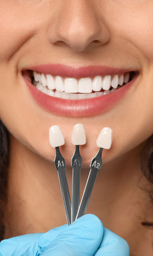 Signature Dental Aesthetics - Porcelain Veneers AAG