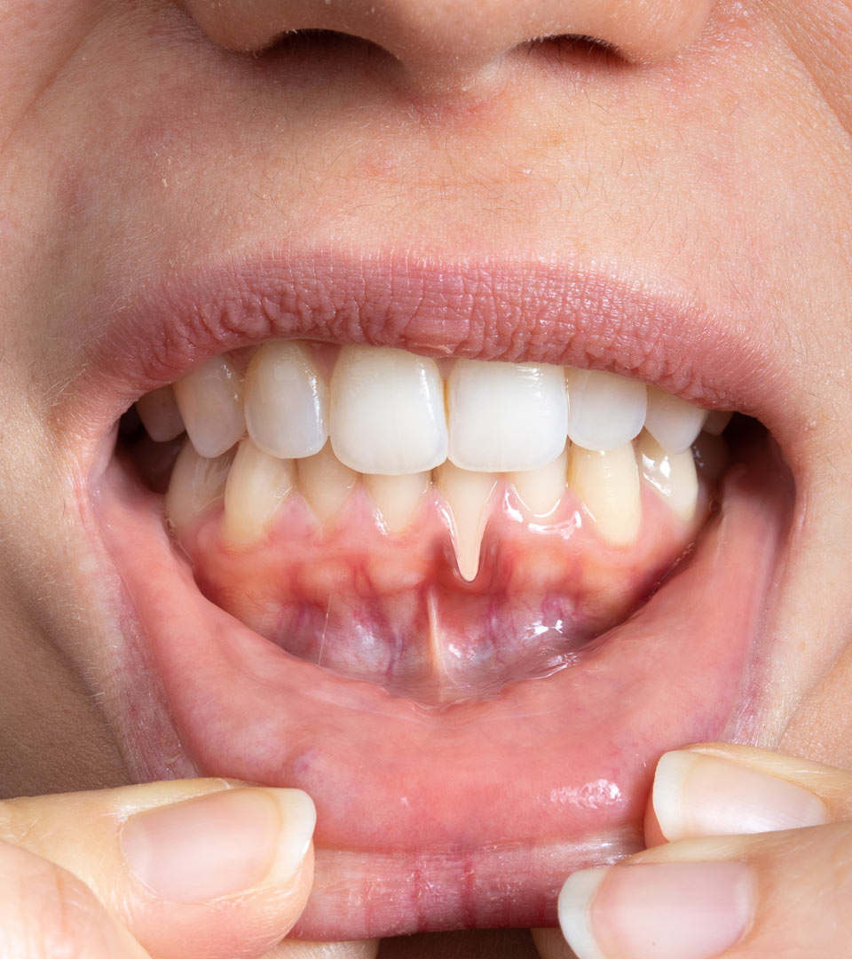 Signature Dental Aesthetics - Receding Gums