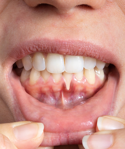 Signature Dental Aesthetics - Receding Gums