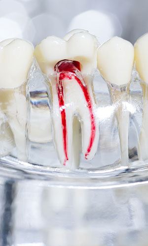 Signature Dental Aesthetics - Root Canal Treatment AAG