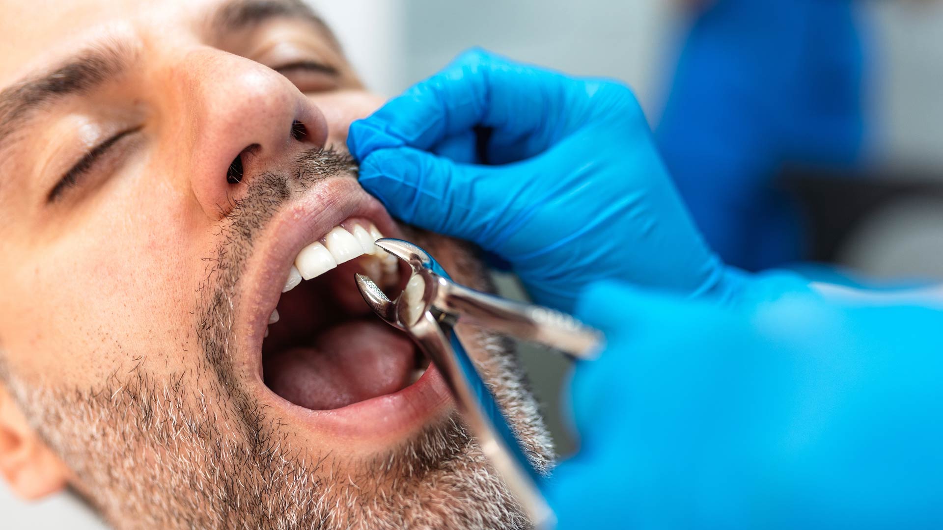 Signature Dental Aesthetics - Simple Tooth Extraction