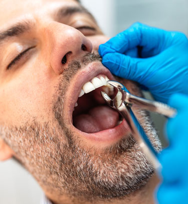 Signature Dental Aesthetics - Simple Tooth Extraction