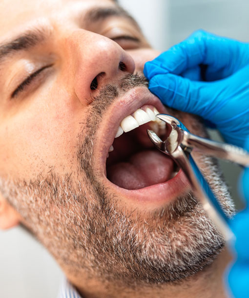 Signature Dental Aesthetics - Simple Tooth Extraction