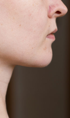Signature Dental Aesthetics - Sinus Lift (Sinus Augmentation) AAG