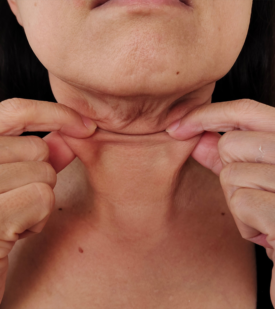Signature Dental Aesthetics - Skin Laxity