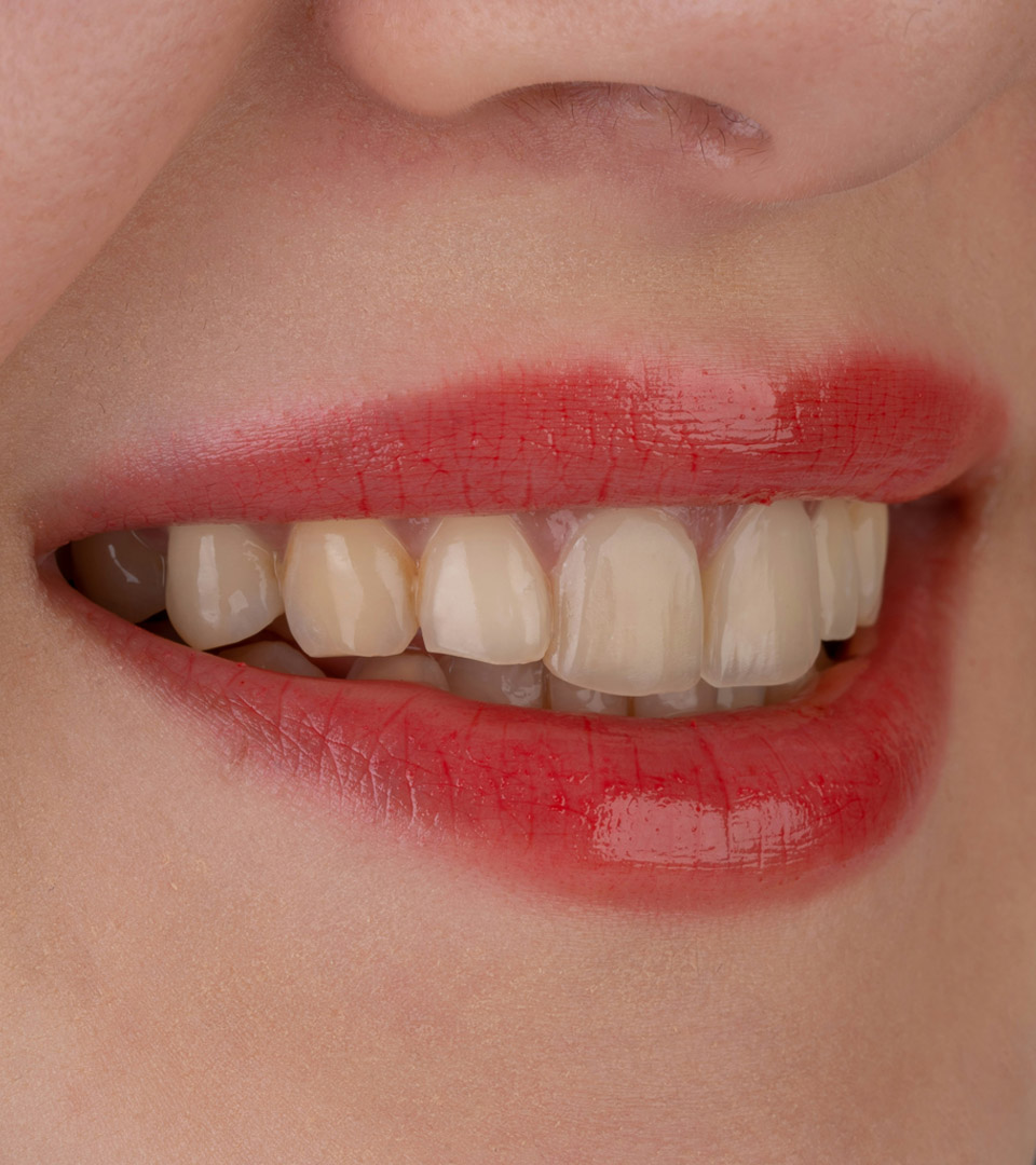 Signature Dental Aesthetics - Stained Teeth