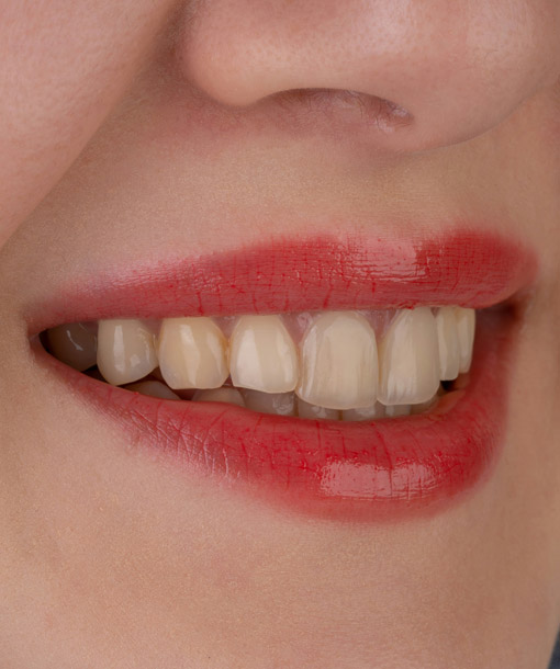 Signature Dental Aesthetics - Stained Teeth