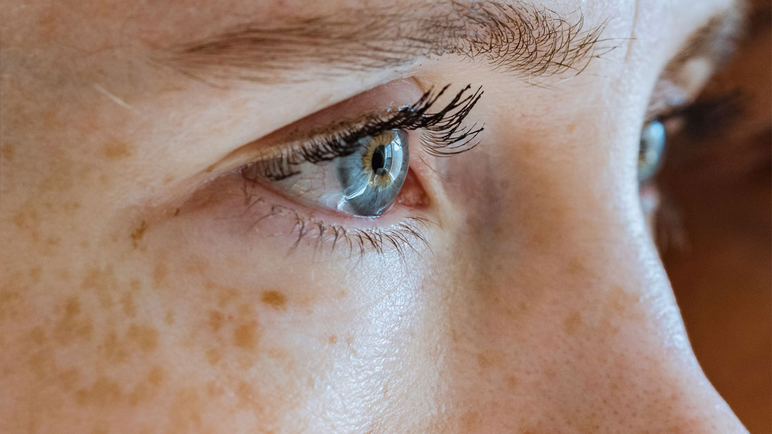 Signature Dental Aesthetics - Sun Damage & Pigmentation Featured