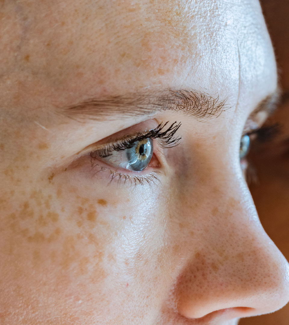 Signature Dental Aesthetics - Sun Damage & Pigmentation