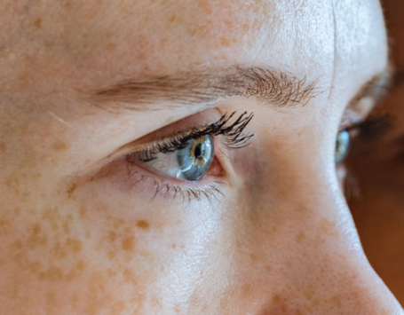 Signature Dental Aesthetics - Sun Damage & Pigmentation