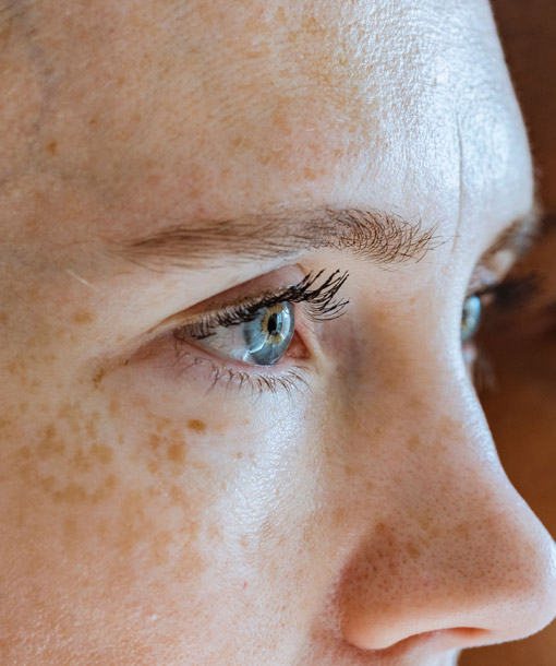 Signature Dental Aesthetics - Sun Damage & Pigmentation