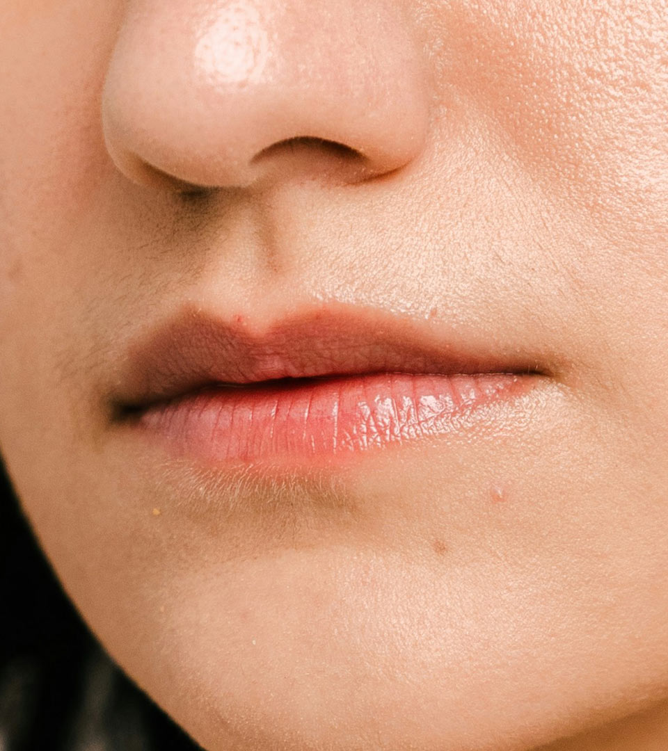 Signature Dental Aesthetics - Thin Lips