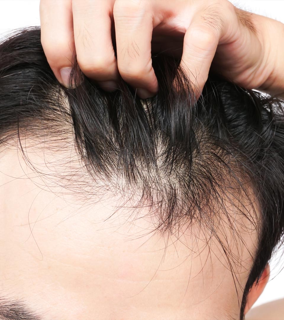 Signature Dental Aesthetics - Thinning Hair