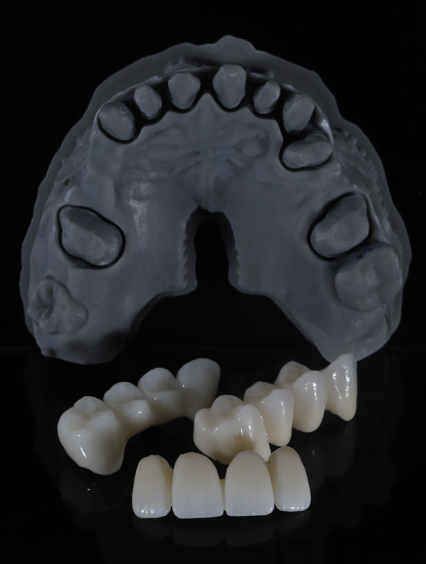 Signature Dental Aesthetics - What Are Bridges