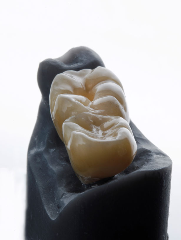 Signature Dental Aesthetics - What Are Crowns