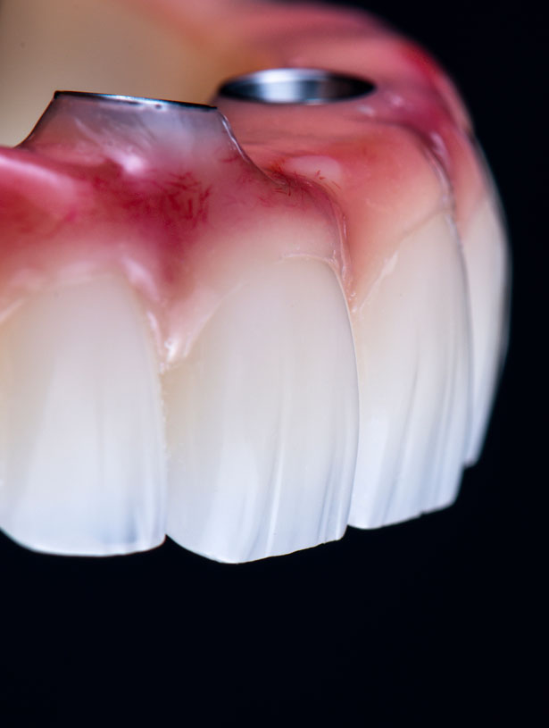 Signature Dental Aesthetics - What Are Full-Arch Implants