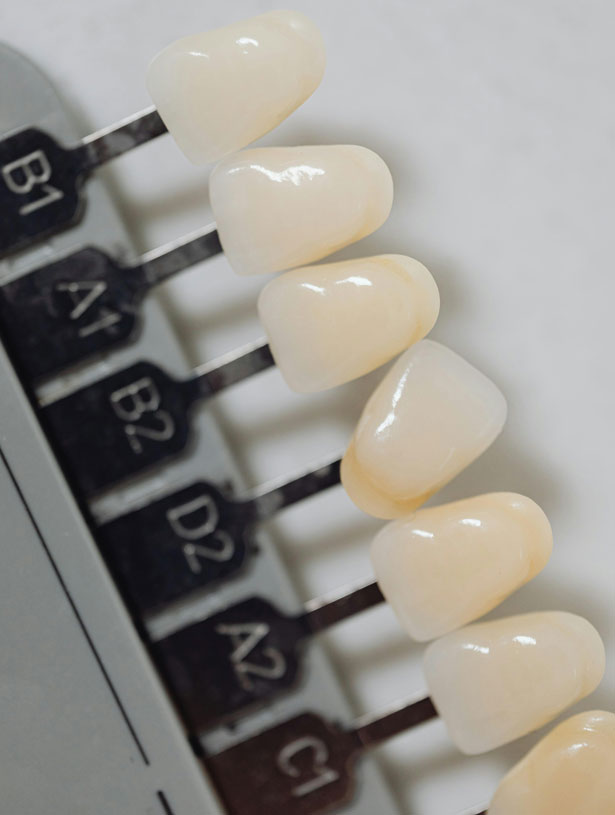 Signature Dental Aesthetics - What Are Porcelain Veneers