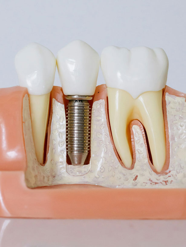 Signature Dental Aesthetics - What Are Simple Implants